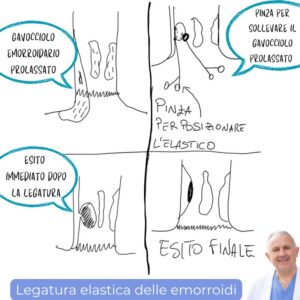 terapia prolasso semplice emorroidi dottor romano linguerri imola bologna castel san pietro terme faenza chirurgia