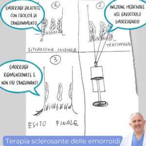 terapia sclerosante emorroidi Romano Linguerri