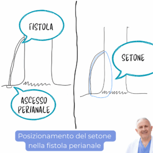 fistola perianale setone intervento chirurgico cura dottor romano linguerri ambulatorio day hospital