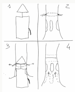 Disegno per tecnica Longo operazioni alle emorroidi