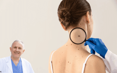 Dopo l’asportazione un nevo cutaneo può ricrescere? Cause e cosa fare