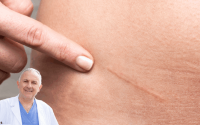 Cicatrice dopo operazione ernia inguinale: come gestirla e quanto si vede?