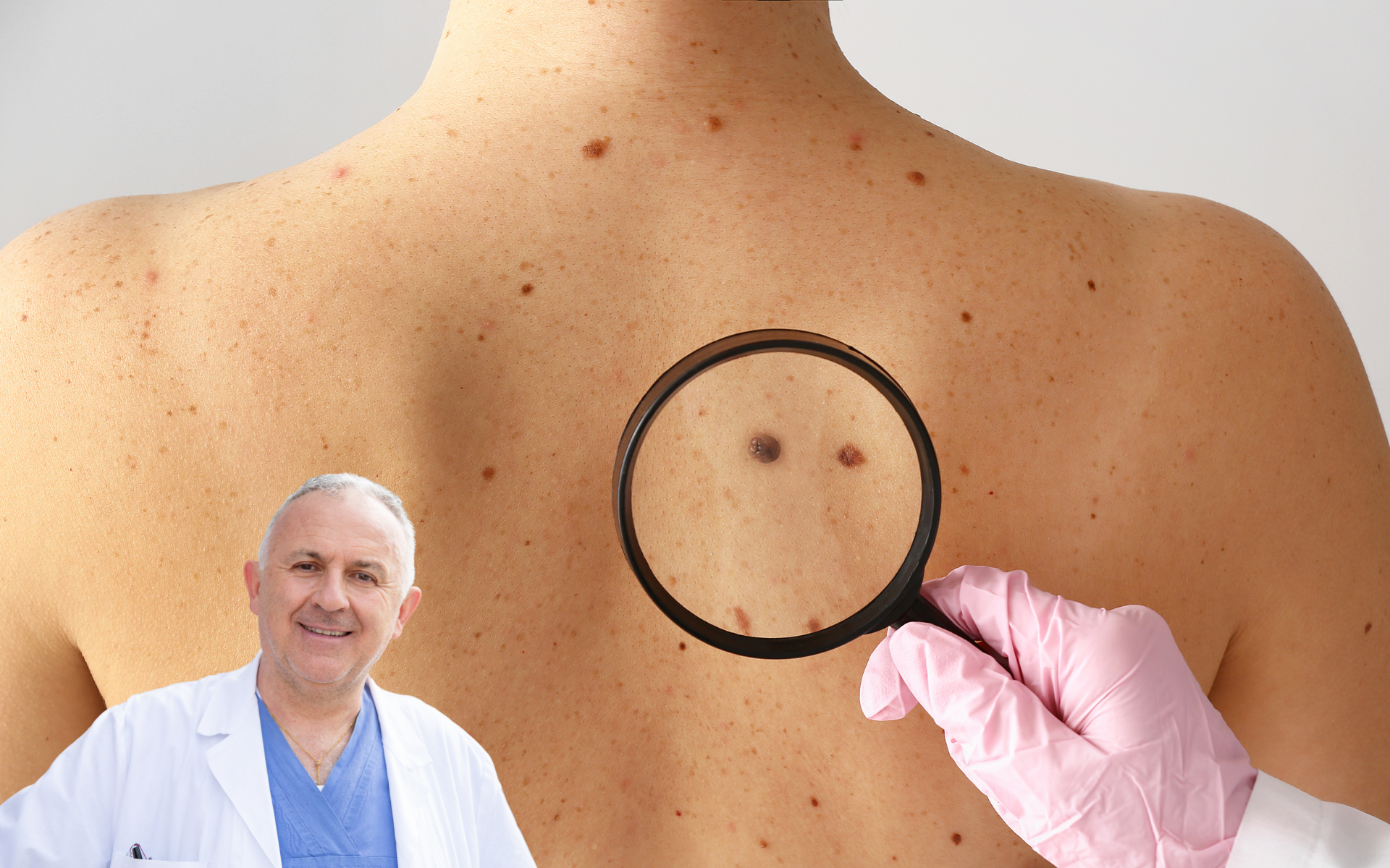 differenza per il chirurgo fra neo piatto e neo in rilievo differenza per il chirurgo fra neo piatto e neo in rilievo nelle operazioni di estrazione dei nevi cutanei