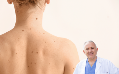 Rimozione neo cutaneo: estetica e cicatrici tra viso e corpo